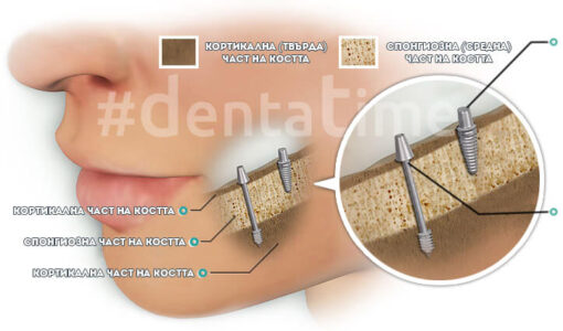 зъбни импланти