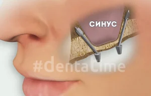 Диаграма на зъбен имплант, показваща неговите компоненти (корона, абатмънт, винт и имплантна фикстура), етапите на сглобяване и завършен имплант, вграден в челюстна кост и венец, до естествен зъб.